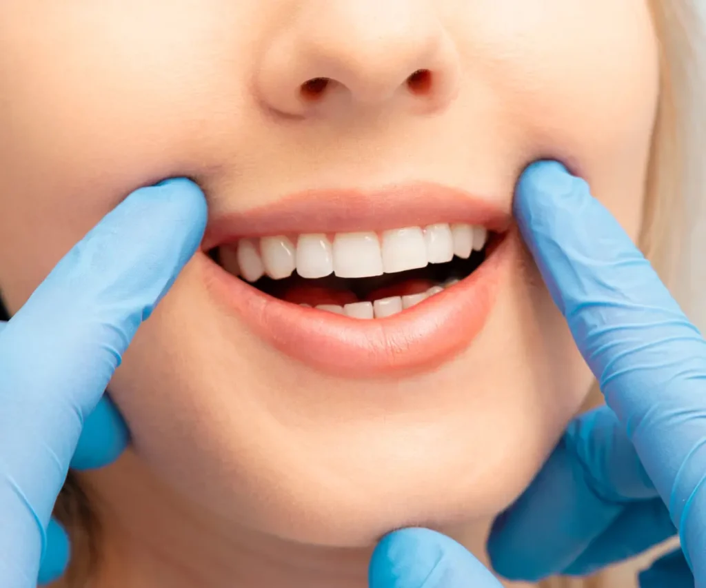 tooth whitening (3)
