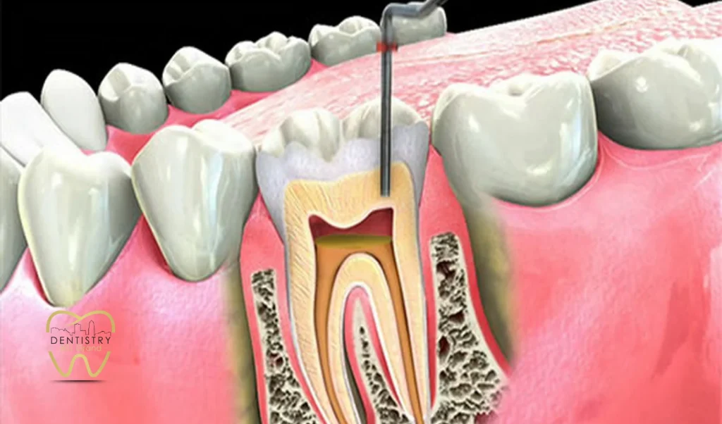 How a Root Canal Procedure is Done