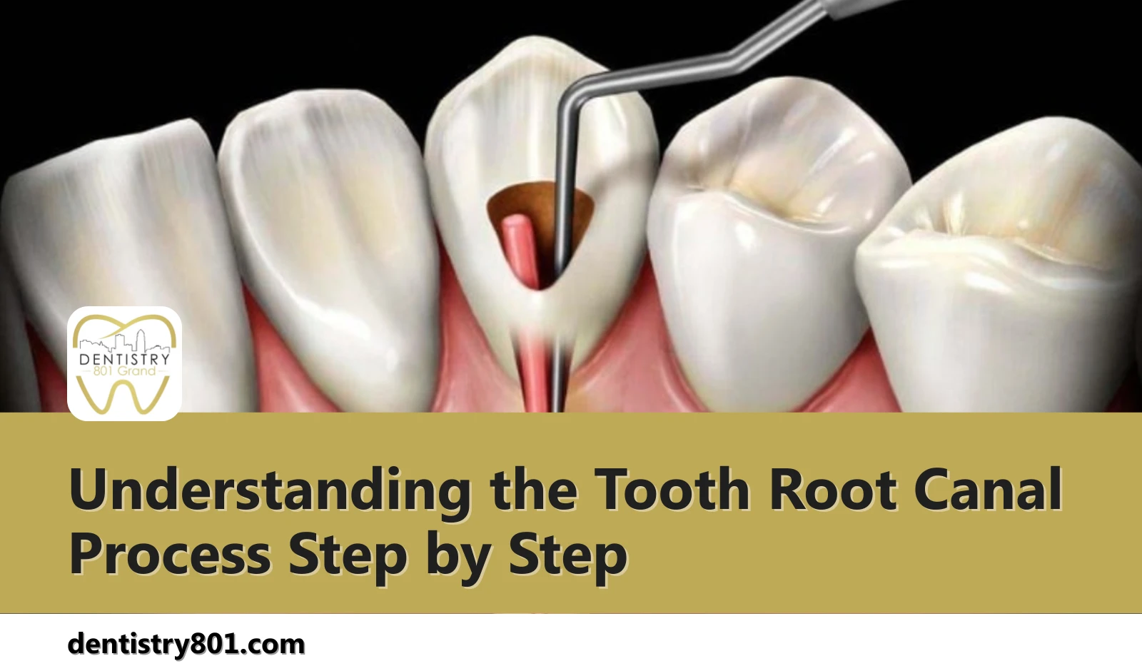 Understanding the Tooth Root Canal Process Step by Step