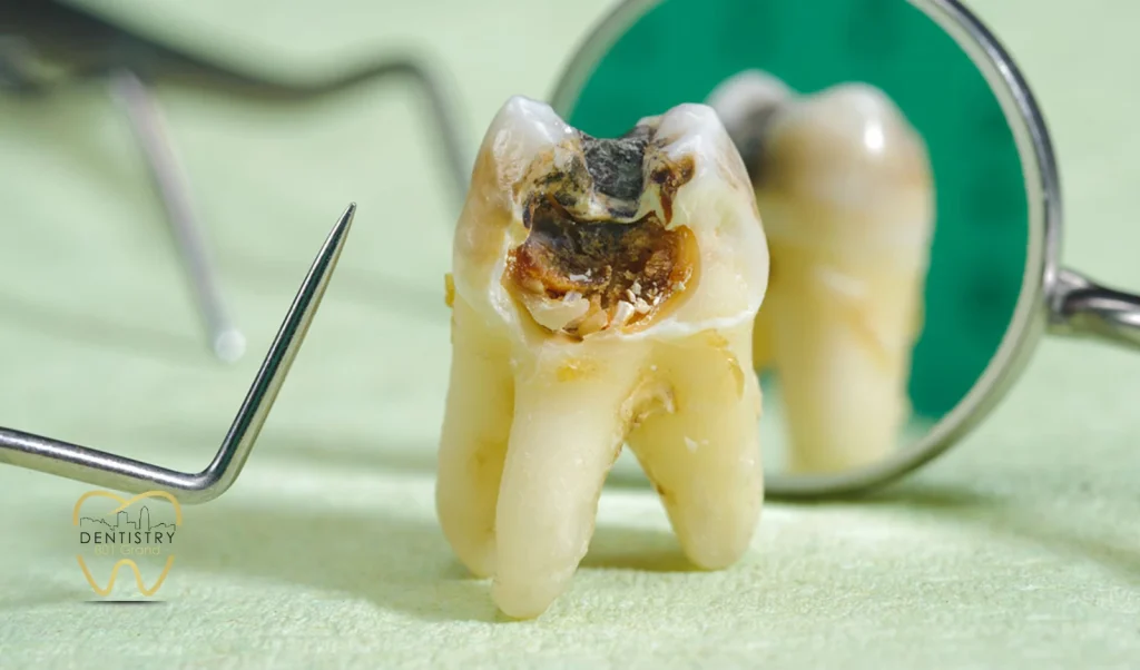 Why a Tooth Might Need a Root Canal Treatment
