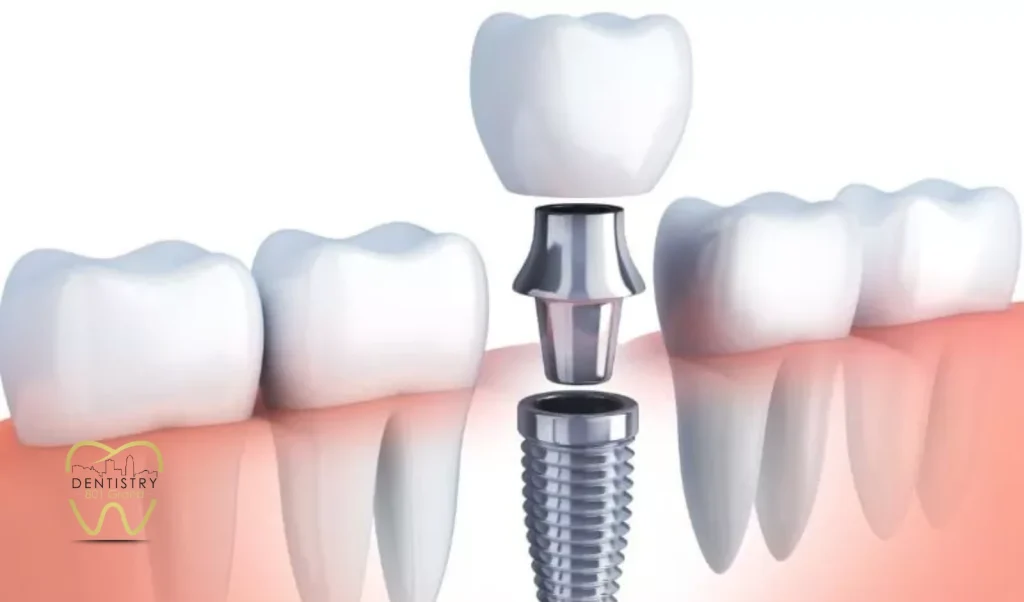 When Tooth Extraction Becomes an Option