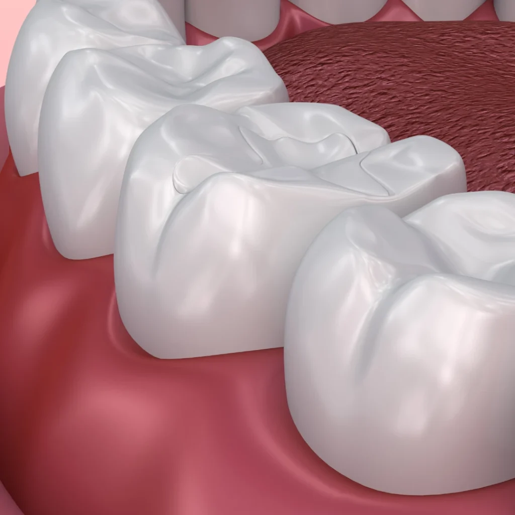 Dental Fillings and Crown