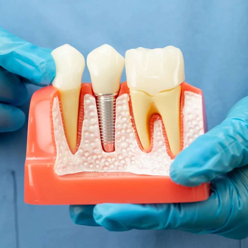 Dental Implant