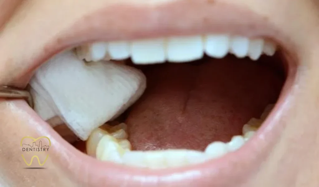 How Is a Dry Socket Treated