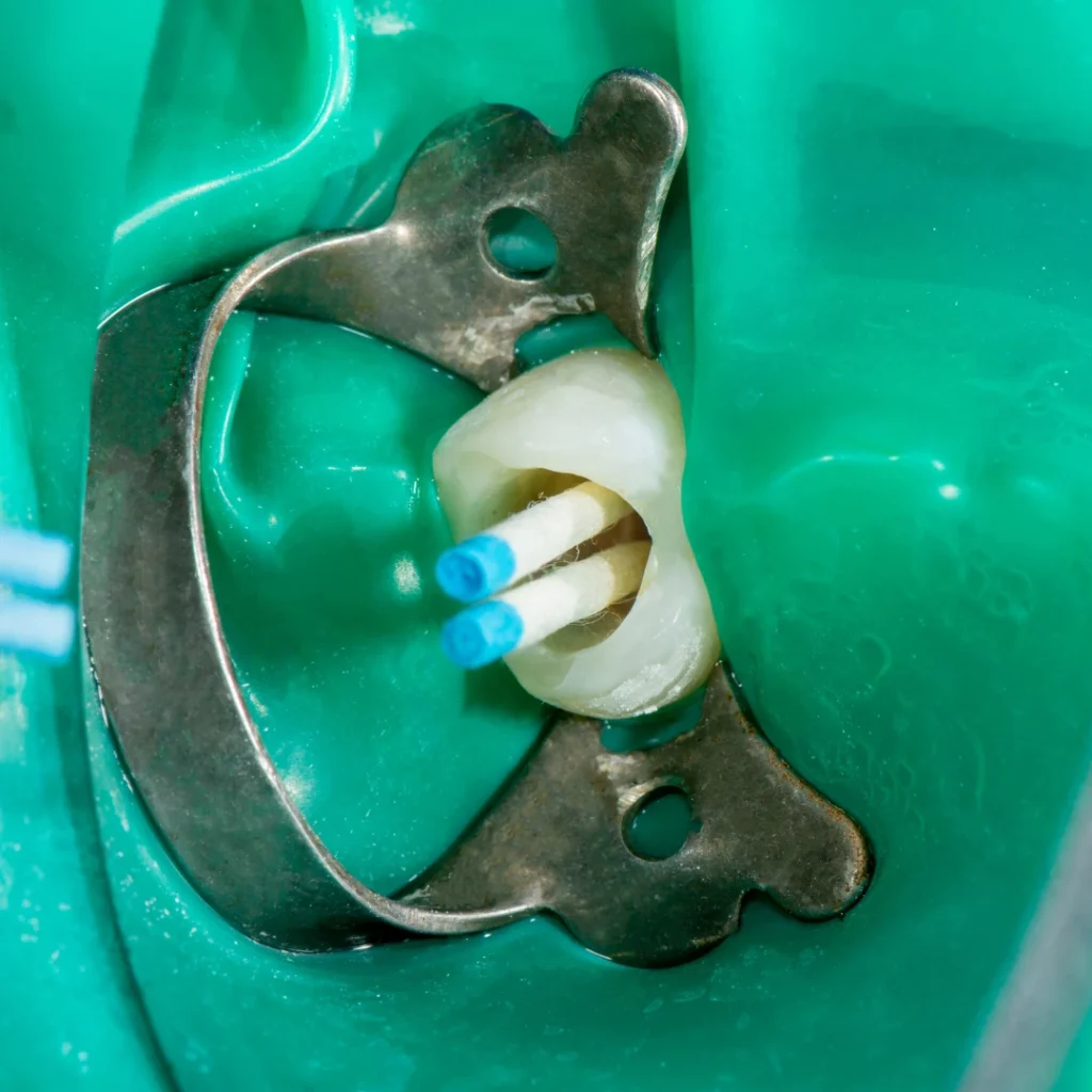 Root Canal Treatment Procedure