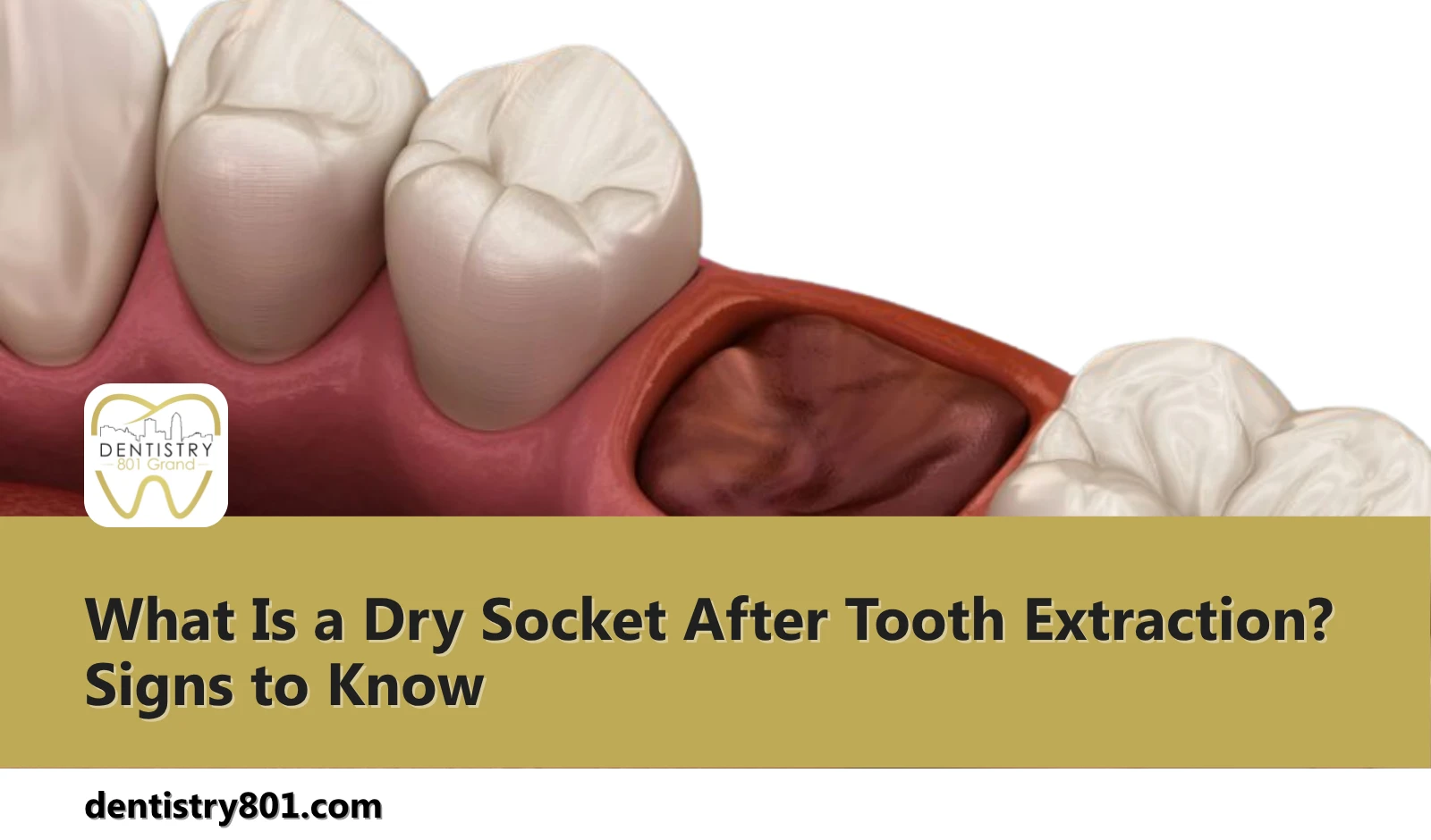 What Is a Dry Socket After Tooth Extraction Signs to Know