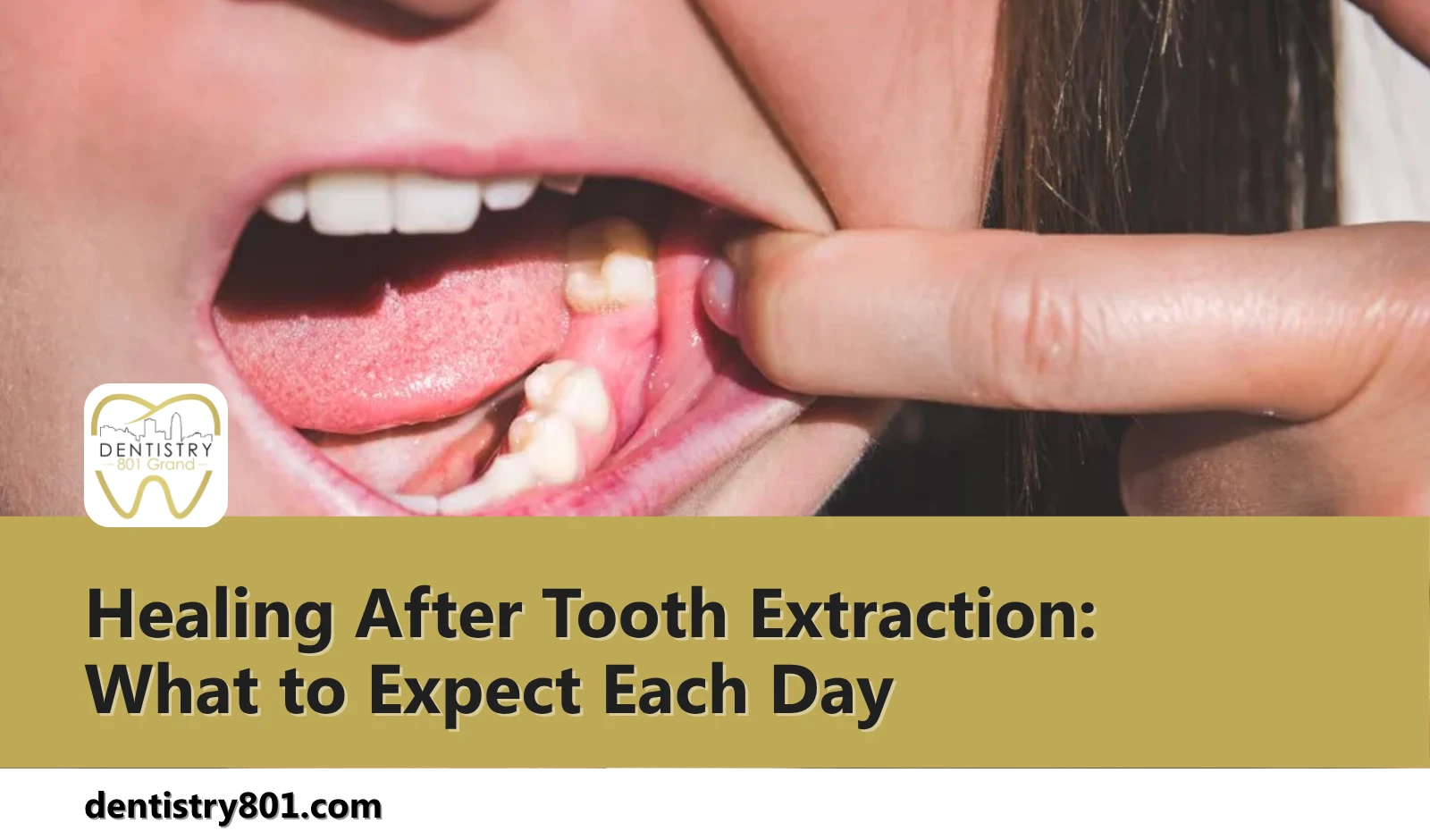 Healing After Tooth Extraction What to Expect Each Day